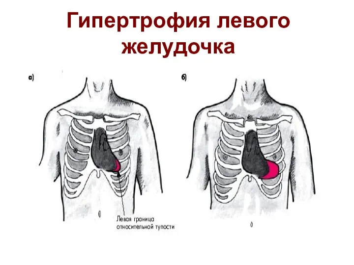 Гипертрофия левого желудочка