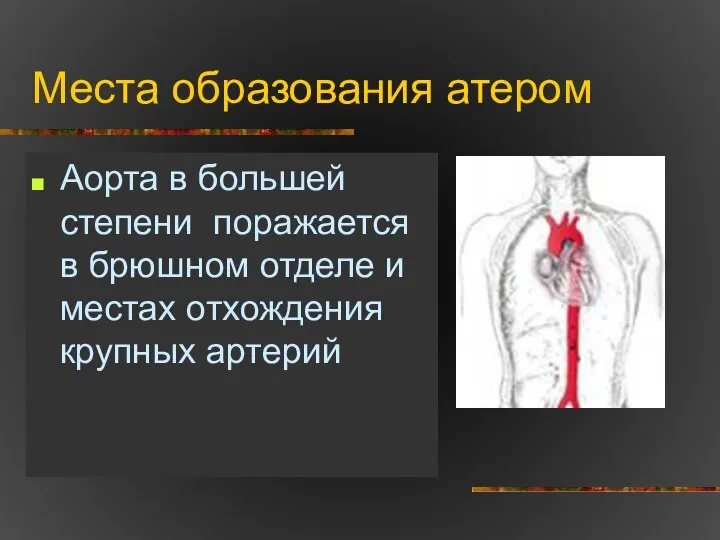 Места образования атером Аорта в большей степени поражается в брюшном отделе и местах отхождения крупных артерий
