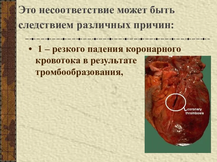 Это несоответствие может быть следствием различных причин: 1 – резкого падения коронарного кровотока в результате тромбообразования,