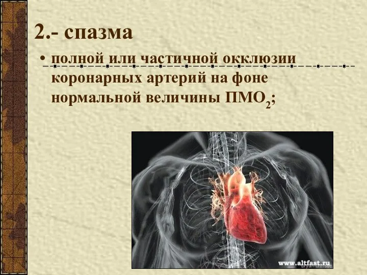 2.- спазма полной или частичной окклюзии коронарных артерий на фоне нормальной величины ПМО2;