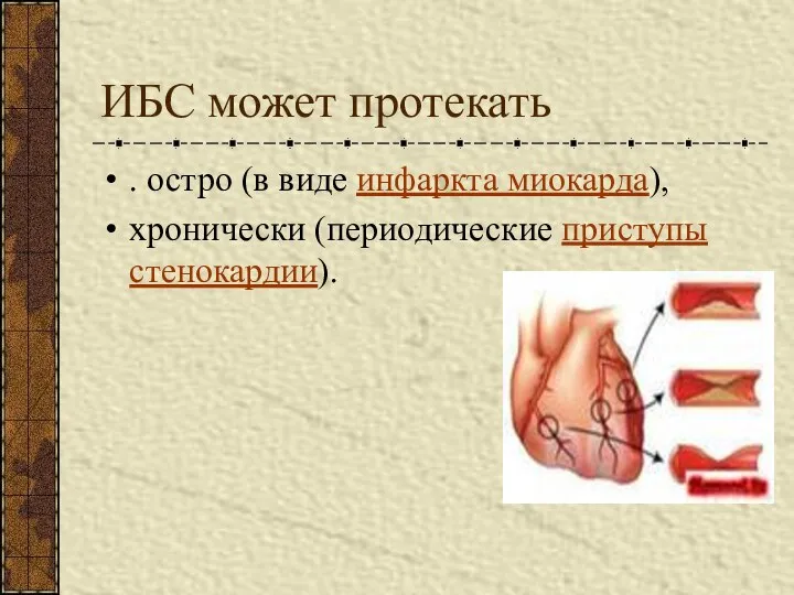 ИБС может протекать . остро (в виде инфаркта миокарда), хронически (периодические приступы стенокардии).