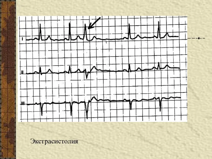 Экстрасистолия