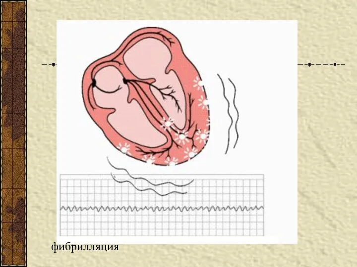 фибрилляция