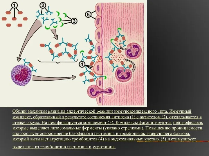 Общий механизм развития аллергической реакции иммунокомплексного типа. Иммунный комплекс, образованный в