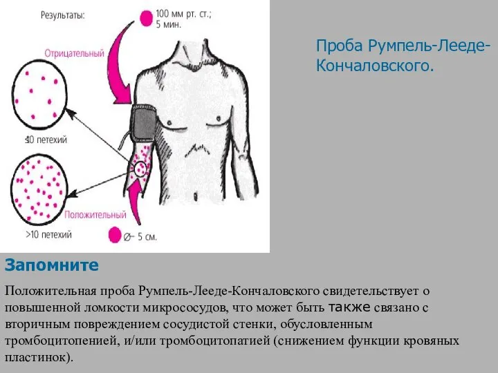 Запомните Положительная проба Румпель-Лееде-Кончаловского свидетельствует о повышенной ломкости микрососудов, что может