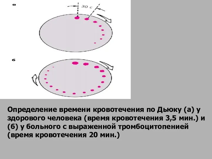 Определение времени кровотечения по Дьюку (а) у здорового человека (время кровотечения