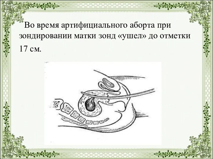 Во время артифициального аборта при зондировании матки зонд «ушел» до отметки 17 см.