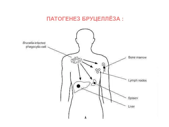 ПАТОГЕНЕЗ БРУЦЕЛЛЁЗА :