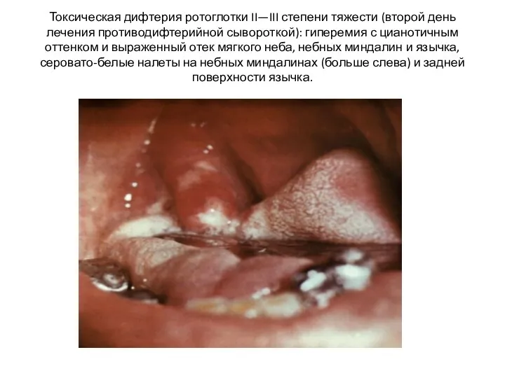 Токсическая дифтерия ротоглотки II—III степени тяжести (второй день лечения противодифтерийной сывороткой):