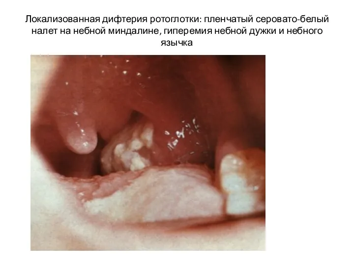 Локализованная дифтерия ротоглотки: пленчатый серовато-белый налет на небной миндалине, гиперемия небной дужки и небного язычка