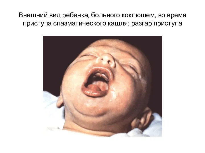 Внешний вид ребенка, больного коклюшем, во время приступа спазматического кашля: разгар приступа