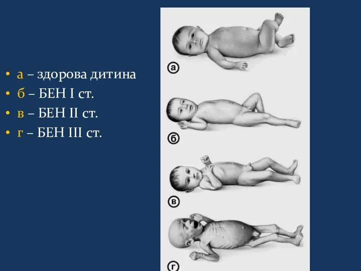 а – здорова дитина б – БЕН I ст. в –