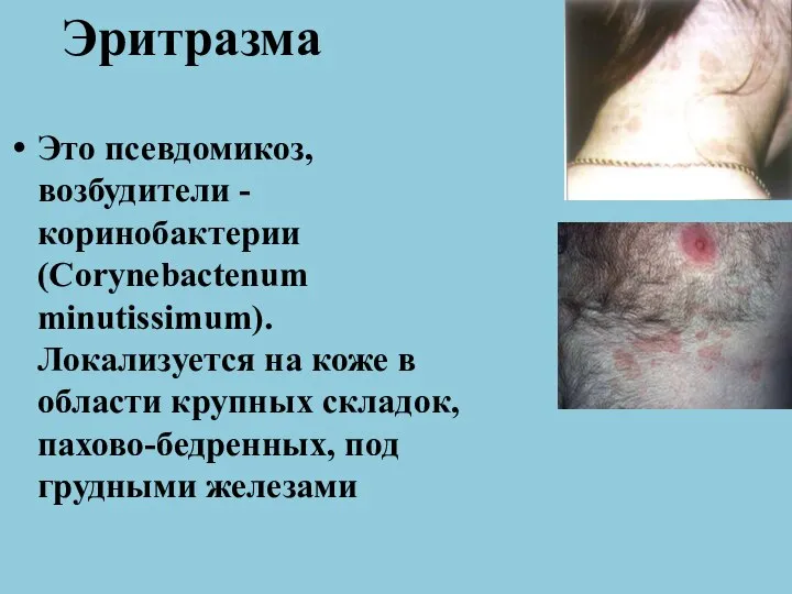 Эритразма Это псевдомикоз, возбудители - коринобактерии (Corynebactenum minutissimum). Локализуется на коже