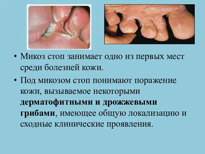 Микоз стоп занимает одно из первых мест среди болезней кожи. Под