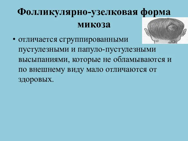 Фолликулярно-узелковая форма микоза отличается сгруппированными пустулезными и папуло-пустулезными высыпаниями, которые не