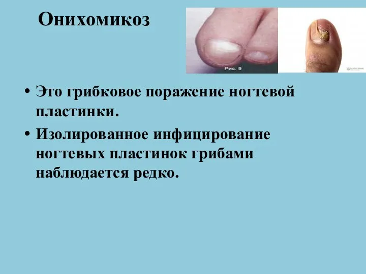 Онихомикоз Это грибковое поражение ногтевой пластинки. Изолированное инфицирование ногтевых пластинок грибами наблюдается редко.