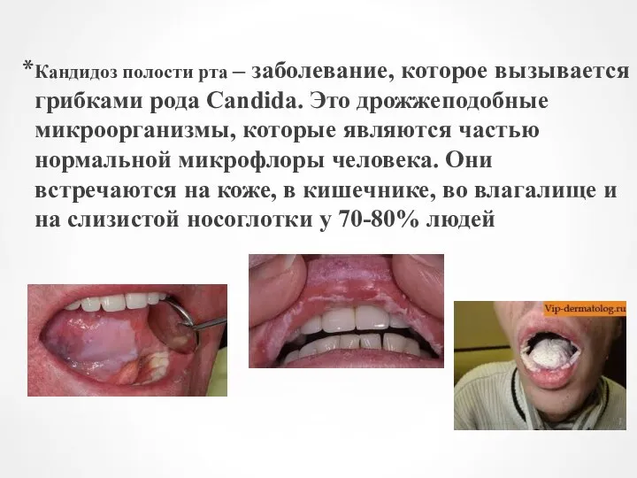 Кандидоз полости рта – заболевание, которое вызывается грибками рода Candida. Это