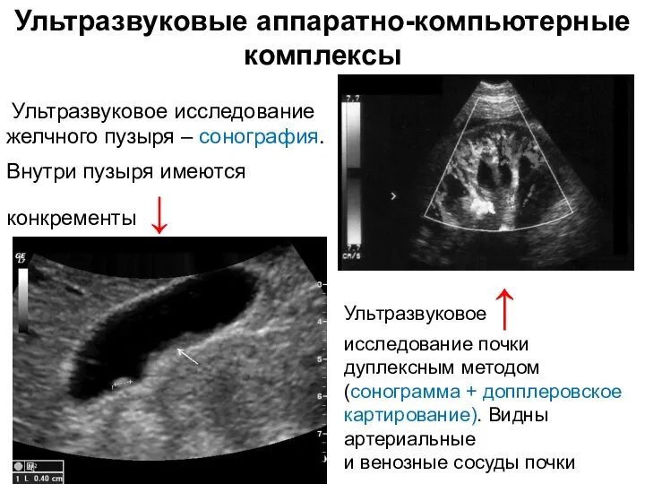 Ультразвуковые аппаратно-компьютерные комплексы Ультразвуковое ↑ исследование почки дуплексным методом (сонограмма +