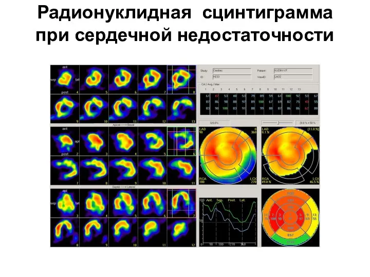 Радионуклидная сцинтиграмма при сердечной недостаточности