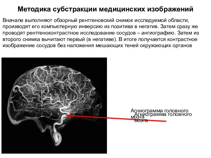 Методика субстракции медицинских изображений Вначале выполняют обзорный рентгеновский снимок исследуемой области,