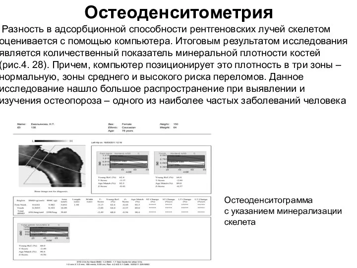 Остеоденситометрия Разность в адсорбционной способности рентгеновских лучей скелетом оценивается с помощью