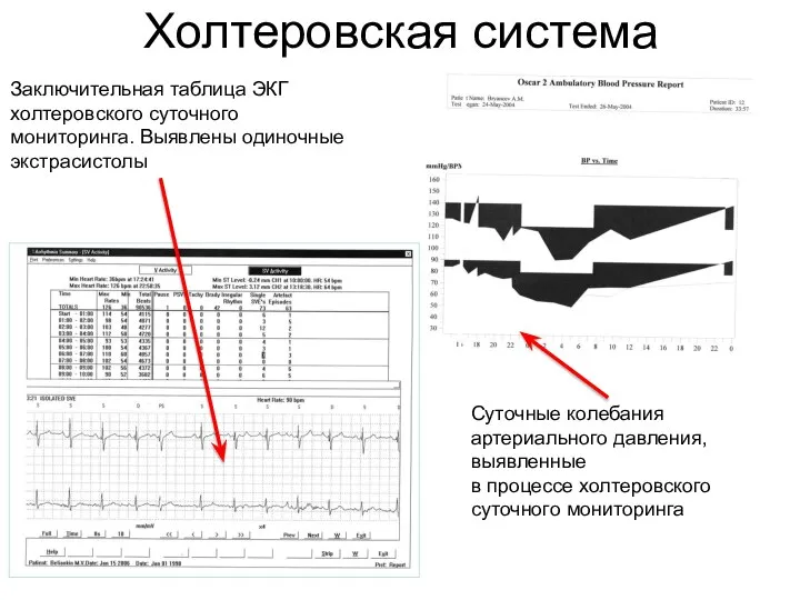 Холтеровская система Заключительная таблица ЭКГ холтеровского суточного мониторинга. Выявлены одиночные экстрасистолы