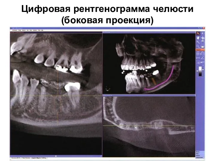 Цифровая рентгенограмма челюсти (боковая проекция)