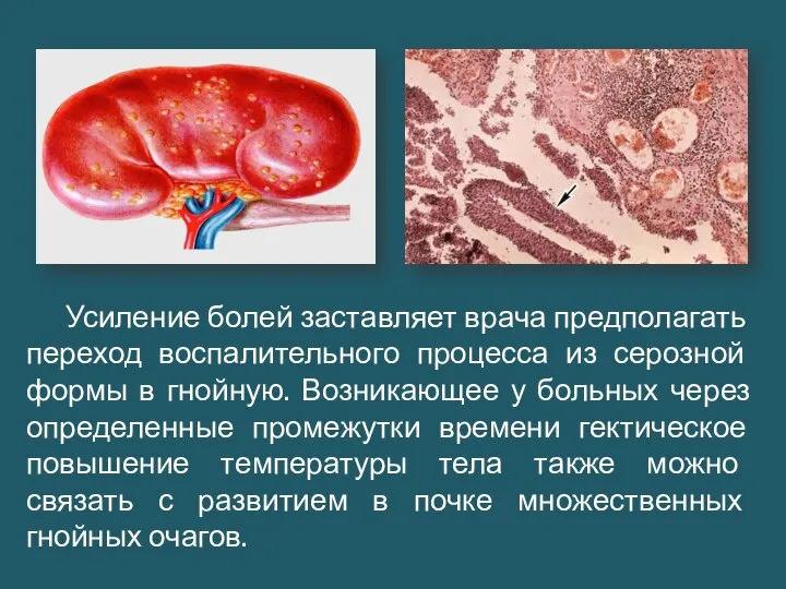 Усиление болей заставляет врача предполагать переход воспалительного процесса из серозной формы