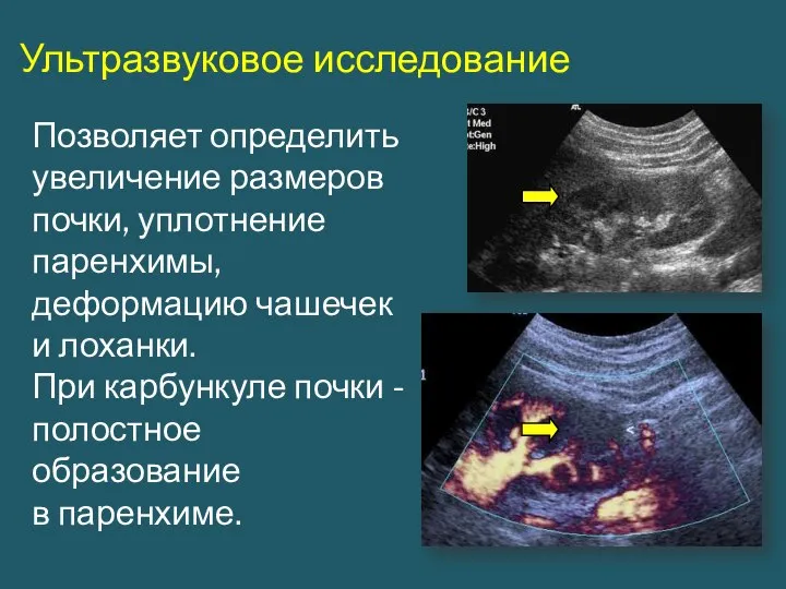 Ультразвуковое исследование Позволяет определить увеличение размеров почки, уплотнение паренхимы, деформацию чашечек