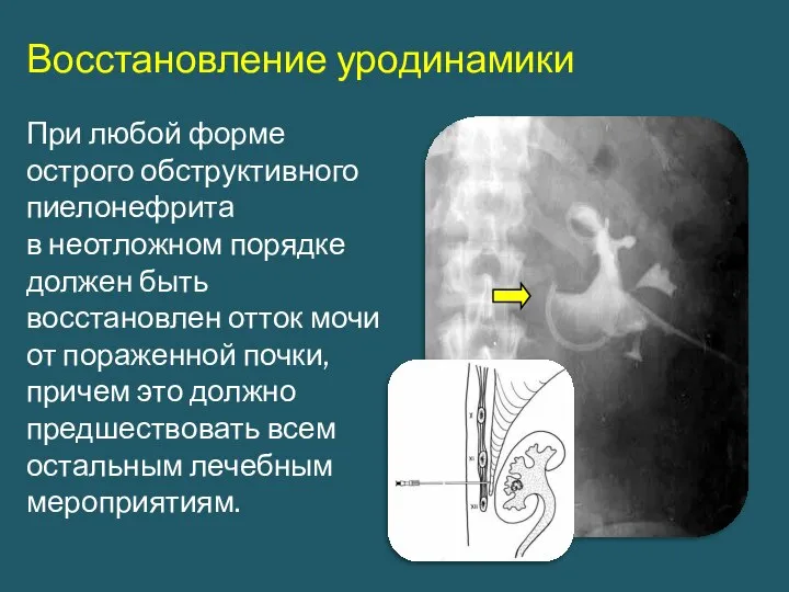 Восстановление уродинамики При любой форме острого обструктивного пиелонефрита в неотложном порядке