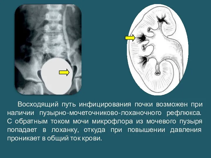 Восходящий путь инфицирования почки возможен при наличии пузырно-мочеточниково-лоханочного рефлюкса. С обратным