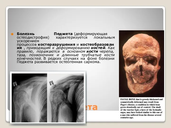 Болезнь Педжета Болезнь Педжета (деформирующая остеодистрофия) характеризуется локальным ускорением процессов костеразрушения