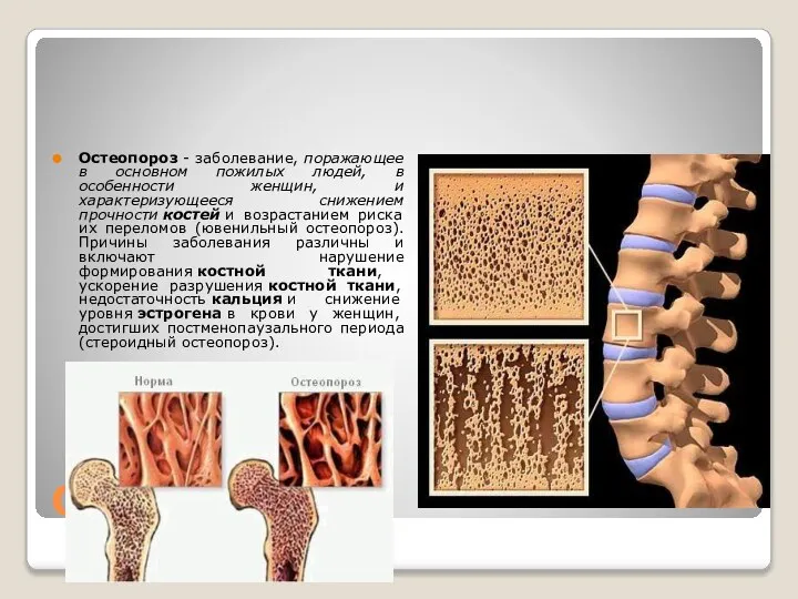 Остеопороз Остеопороз - заболевание, поражающее в основном пожилых людей, в особенности