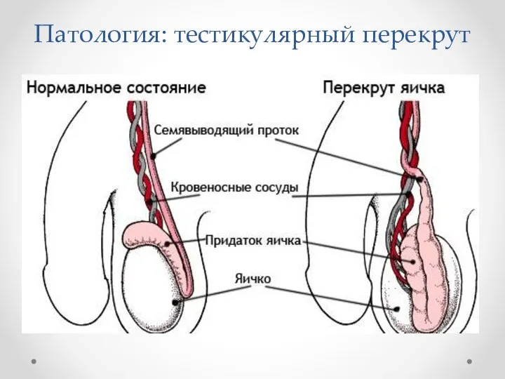 Патология: тестикулярный перекрут