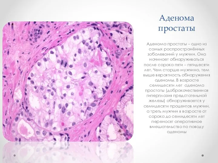 Аденома простаты Аденома простаты – одно из самых распространённых заболеваний у