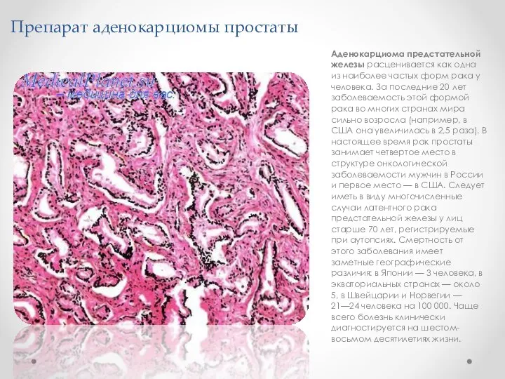 Препарат аденокарциомы простаты Аденокарциома предстательной железы расценивается как одна из наиболее