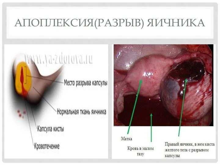 АПОПЛЕКСИЯ(РАЗРЫВ) ЯИЧНИКА