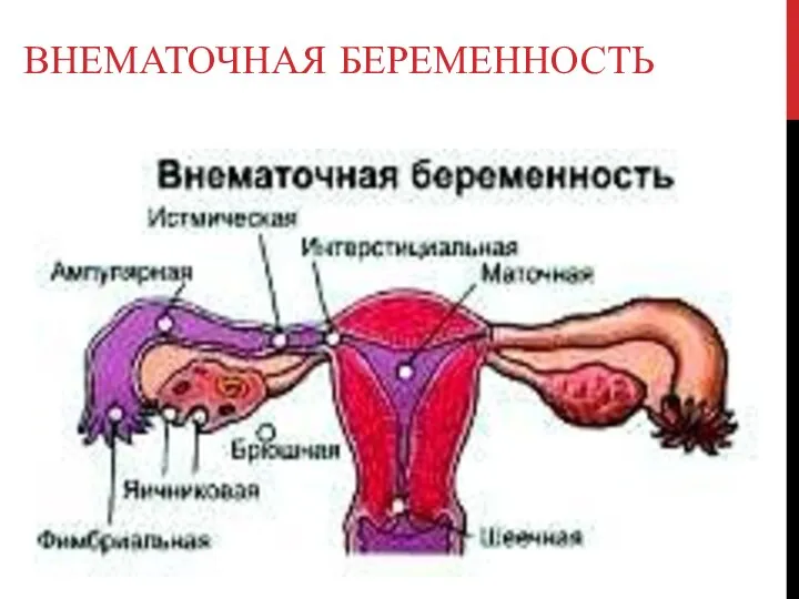 ВНЕМАТОЧНАЯ БЕРЕМЕННОСТЬ