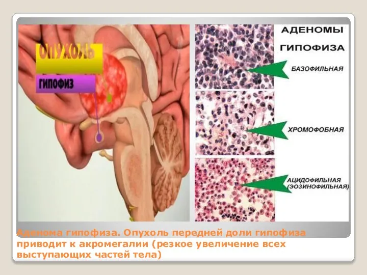 Аденома гипофиза. Опухоль передней доли гипофиза приводит к акромегалии (резкое увеличение всех выступающих частей тела)