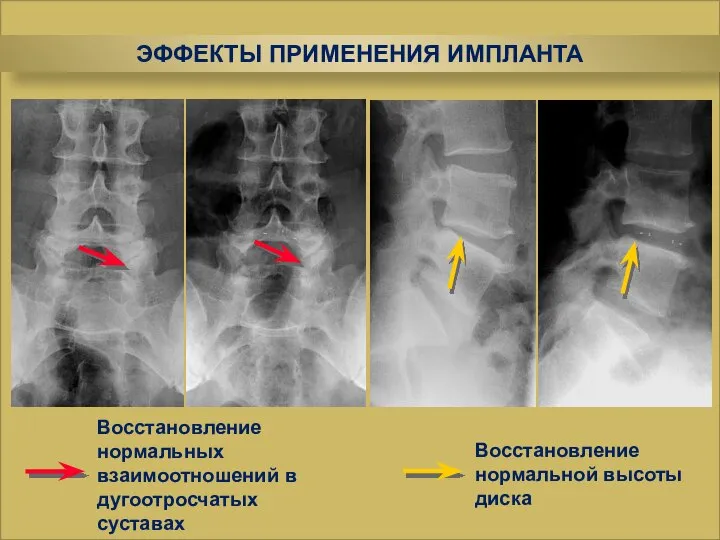 Восстановление нормальных взаимоотношений в дугоотросчатых суставах Восстановление нормальной высоты диска ЭФФЕКТЫ ПРИМЕНЕНИЯ ИМПЛАНТА