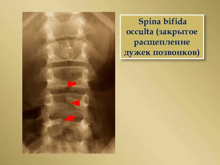 Spina bifida occulta (закрытое расщепление дужек позвонков)