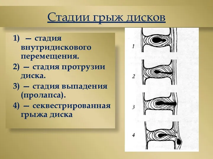 Стадии грыж дисков 1) — стадия внутридискового перемещения. 2) — стадия