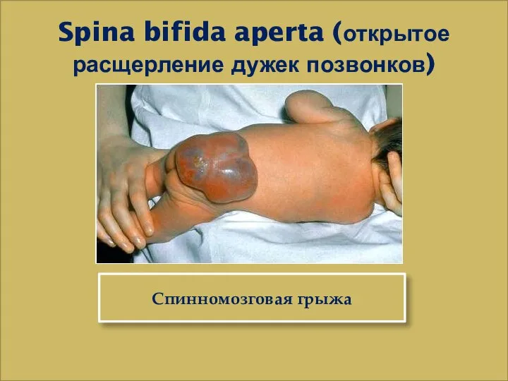 Spina bifida aperta (открытое расщерление дужек позвонков) Спинномозговая грыжа