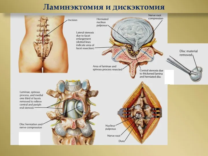 Ламинэктомия и дискэктомия