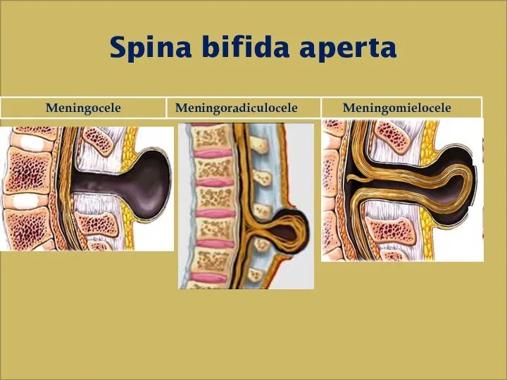 Spina bifida aperta Meningomielocele Meningoradiculocele Meningocele
