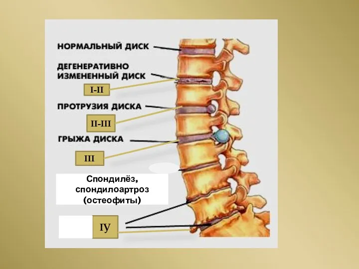 Спондилёз, спондилоартроз (остеофиты) I-II II-III III IУ