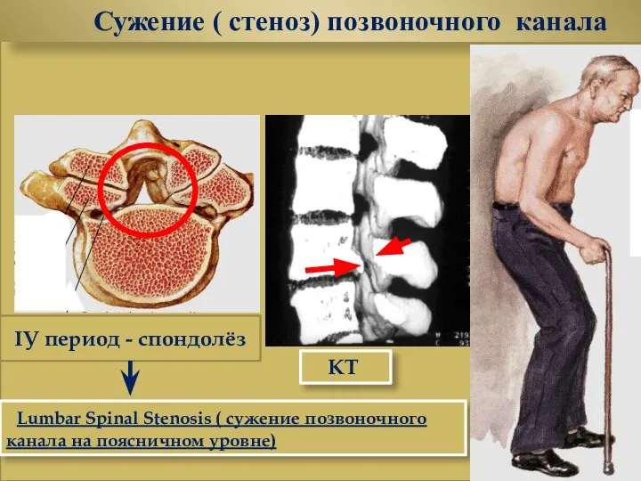 Сужение ( стеноз) позвоночного канала КТ Lumbar Spinal Stenosis ( сужение
