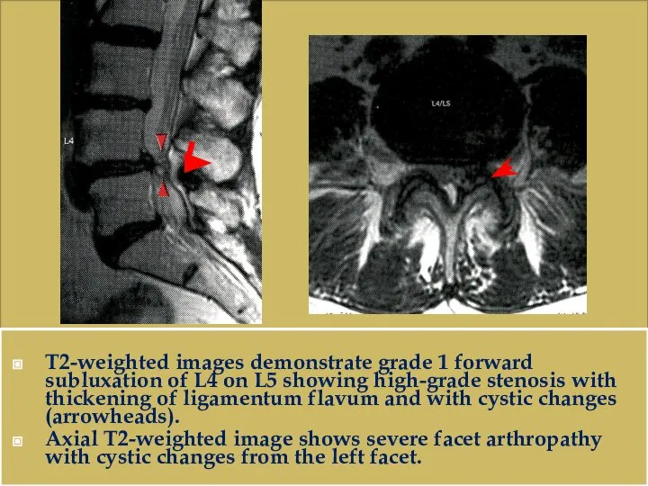 T2-weighted images demonstrate grade 1 forward subluxation of L4 on L5