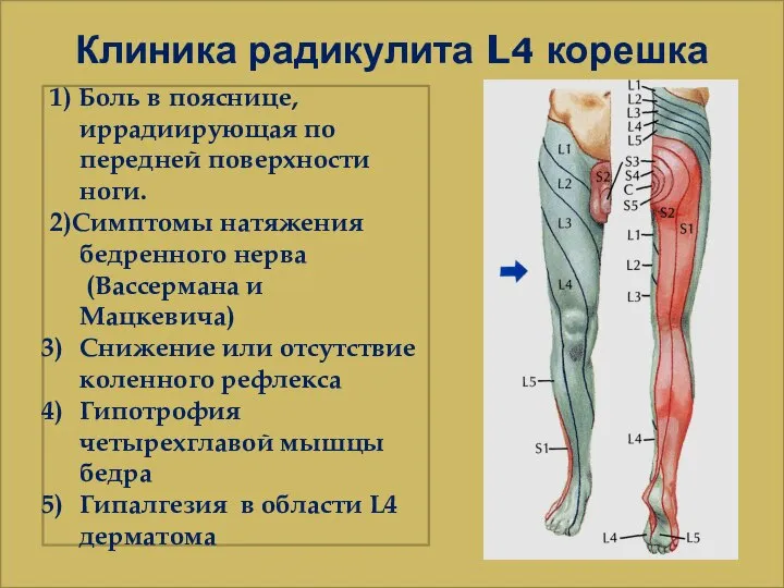 Клиника радикулита L4 корешка 1) Боль в пояснице, иррадиирующая по передней