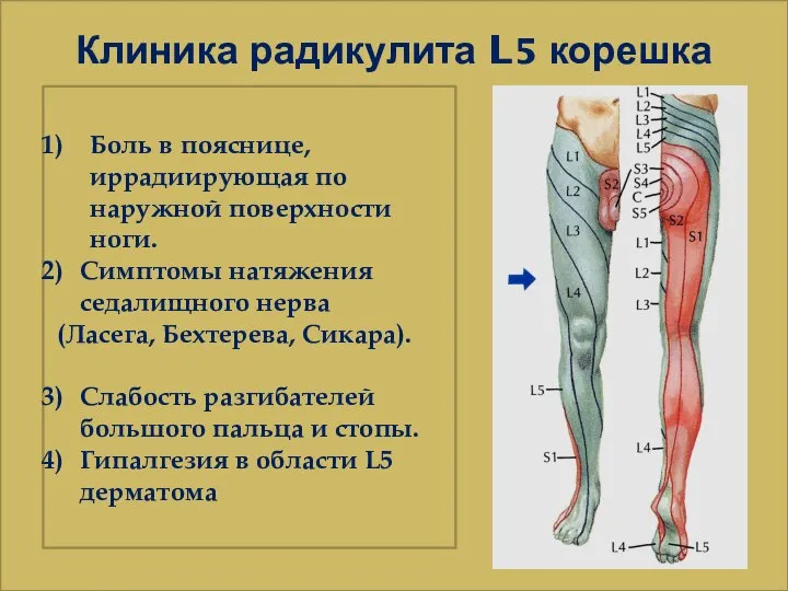 Клиника радикулита L5 корешка Боль в пояснице, иррадиирующая по наружной поверхности
